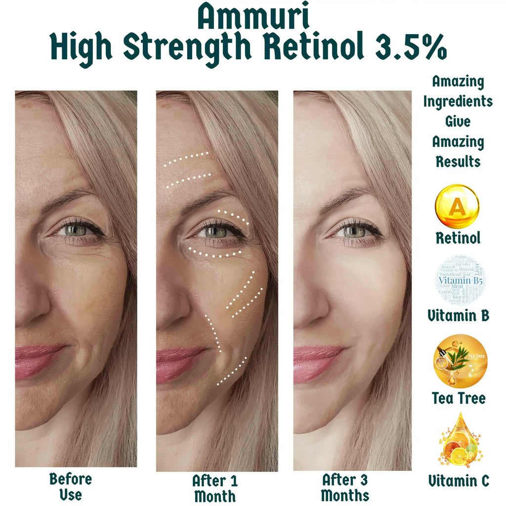 Ammuri High Strength Retinol 3.5% Supercharged Serum results showcasing before use, after one month, and after three months