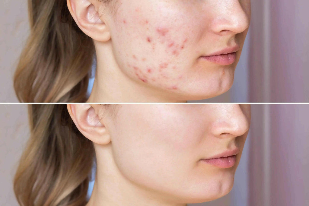 Before and after showing skin improvement using organic black seed oil for acne treatment
